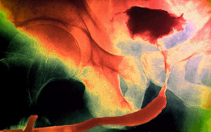 Image: Colored urogram (X-ray) of the pelvis of a patient with a malignant (cancerous) tumor (black) in the bladder (Photo courtesy of Sovereign, ISM).